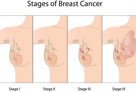 stage-breast-cancer
